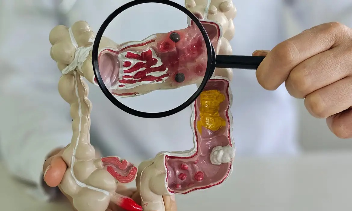 Casos de doenças intestinais aumentam cinco vezes no Brasil